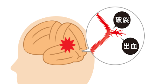 脳出血(脳内出血)の治療：イメージ画像