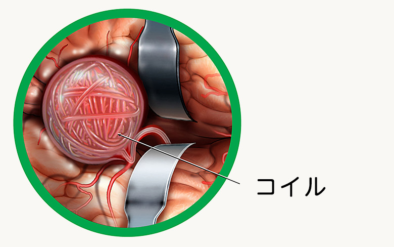 血管内治療による脳動脈瘤の塞栓術:イメージ画像